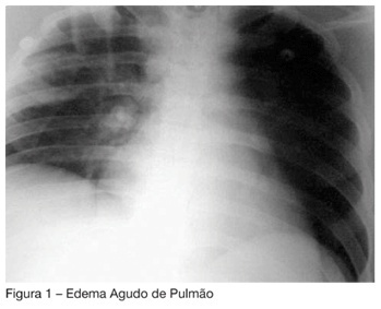 Acute nitrogen intoxication by patient inhalation with breathing insufficiency and coma: case report