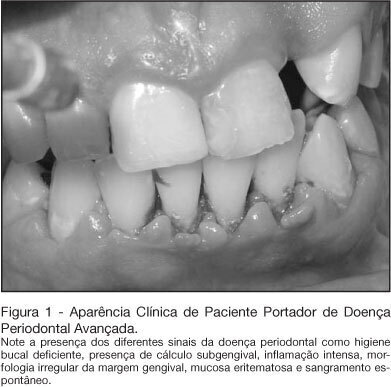 Importance of dental work in patients under intensive care unit