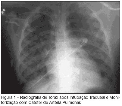 Varicella pneumonia complicated with acute respiratory distress syndrome: two cases report