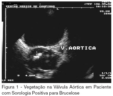 Brucella endocarditis: case report