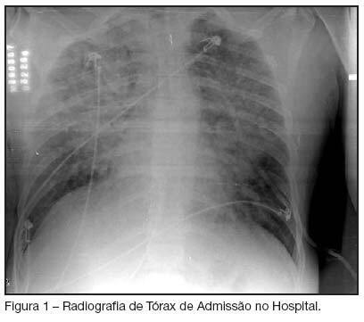 Síndrome pulmonar por hantavírus com disfunção de múltiplos órgãos: relato de caso
