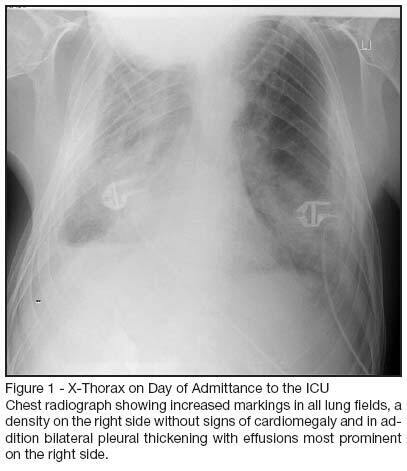 Failure to wean caused by cryptogenic fibrosing pleuritis and bilateral lung trapping: case report