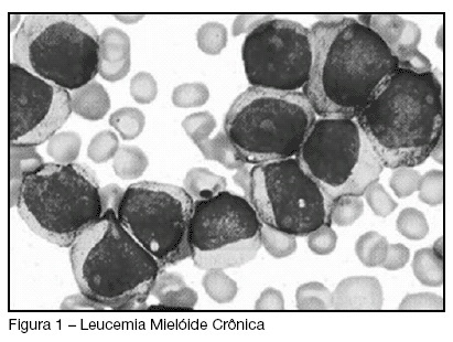Leucemia mielóide crônica e síndrome de hiper-viscosidade: relato de caso