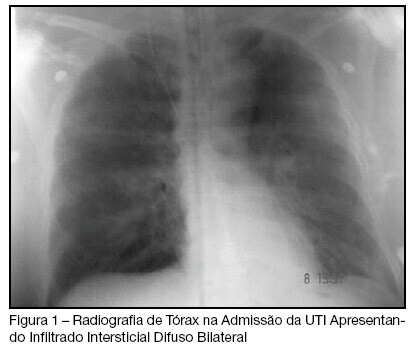 Transfusion-related acute lung injury em pós-operatório de neurocirurgia: relato de caso