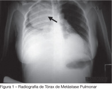 The use of noninvasive mechanical ventilation in the palliative care of a patient with metastatic thoracic sarcoma: case report