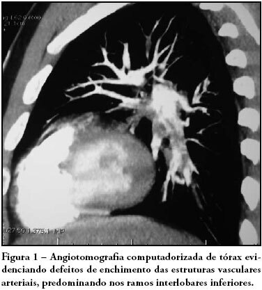 Intra-arterial pulmonary thrombolysis at the postoperative period of brain aneurysm clamping: case report