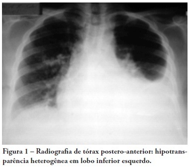 Massa tumoral secundária a infecção por Schistosoma mansoni simulando neoplasia de pulmão: relato de caso