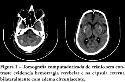 Hypernatremic hemorrhagic encephalopaty: case report and literature review