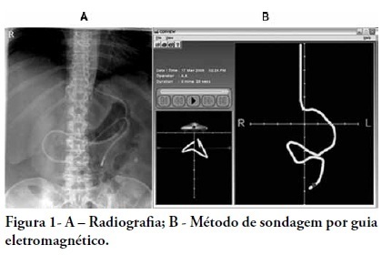 Effectiveness of post-pyloric tube placement using magnetic guidance