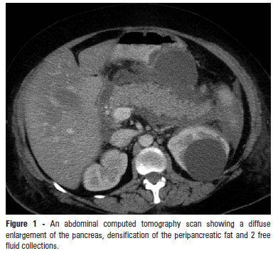 Plasmapheresis as a therapeutic approach for hypertriglyceridemia-induced acute pancreatitis