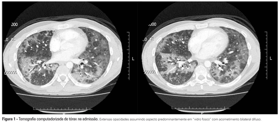 Insuficiência respiratória aguda causada por pneumonia em organização secundária à terapia antineoplásica para linfoma não Hodgkin