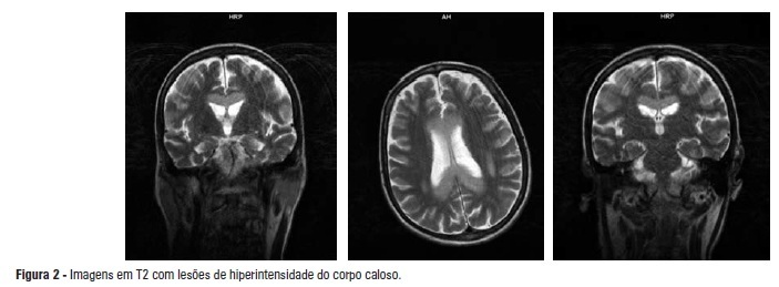 Doença de Marchiafava-Bignami: uma rara entidade com prognóstico sombrio