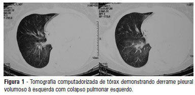 Hematoma subdural agudo espontâneo e hemorragia intracerebral em paciente com microangiopatia trombótica gestacional