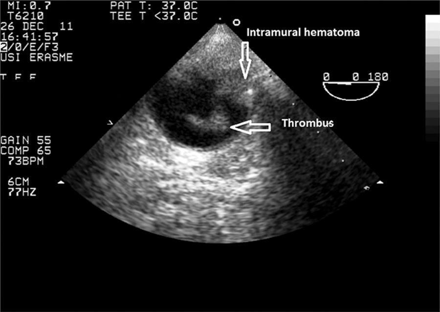 Aortic luminal thrombus and intramural hematoma after
               cardiopulmonary resuscitation