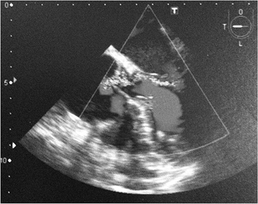 Platypnea-orthodeoxia syndrome in patients presenting enlarged aortic
               root: case report and literature review