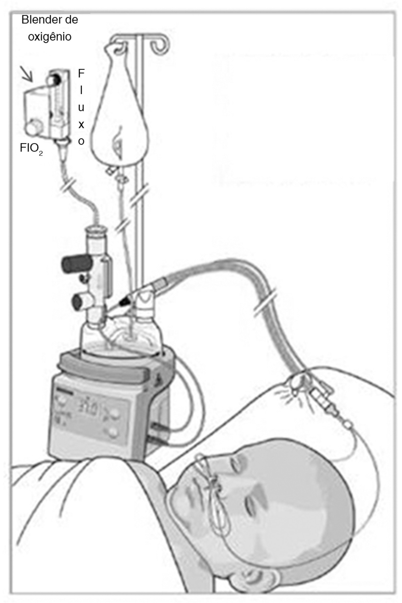 Post-extubation atelectasis in newborns with surgical diseases: a report
               of two cases involving the use of a high-flow nasal cannula