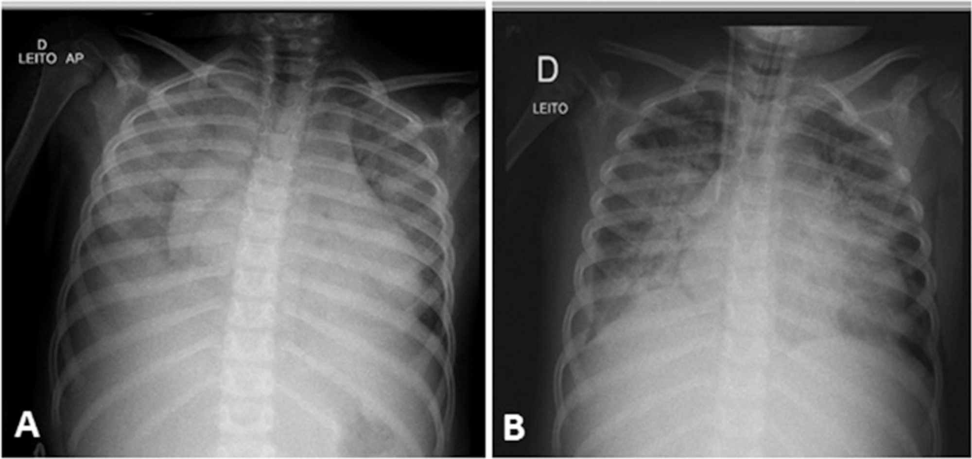 Fulminant myocarditis associated with the H1N1 influenza virus: case
               report and literature review