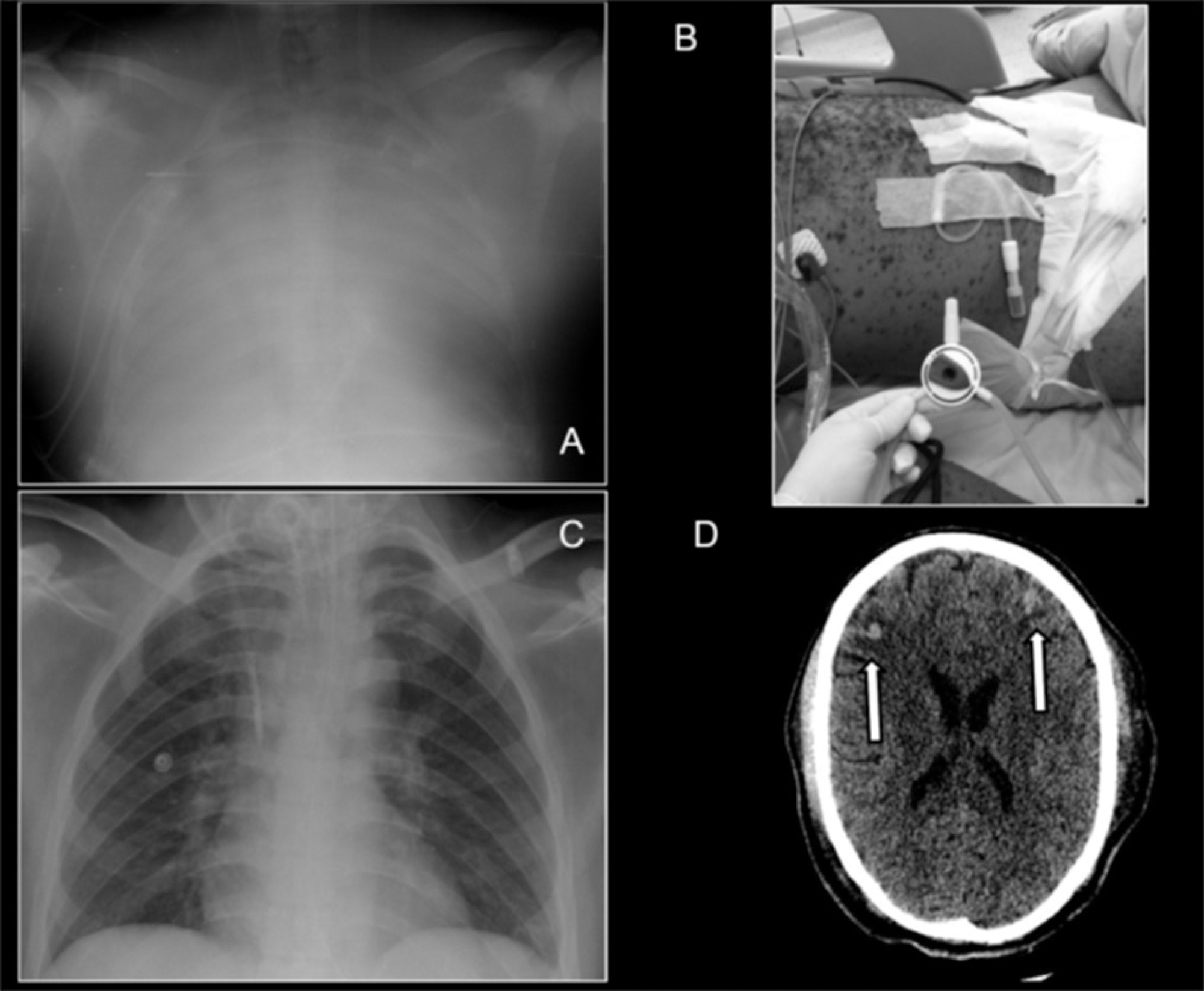 Varicella associated acute respiratory distress syndrome in an adult
               patient: an example for extracorporeal respiratory support in Brazilian endemic
               diseases