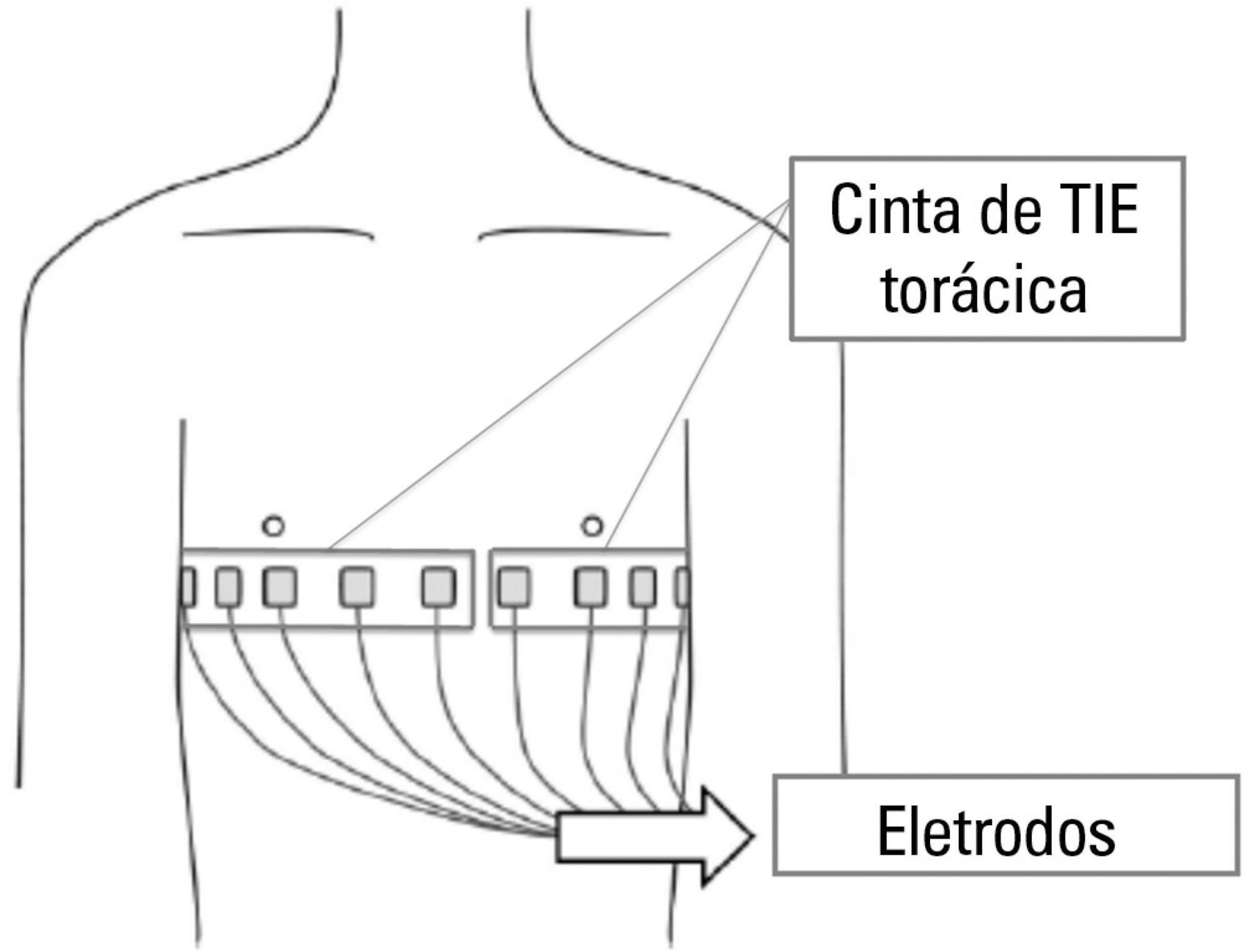 Use of thoracic electrical impedance tomography as an auxiliary tool for alveolar recruitment maneuvers in acute respiratory distress syndrome: case report and brief literature review