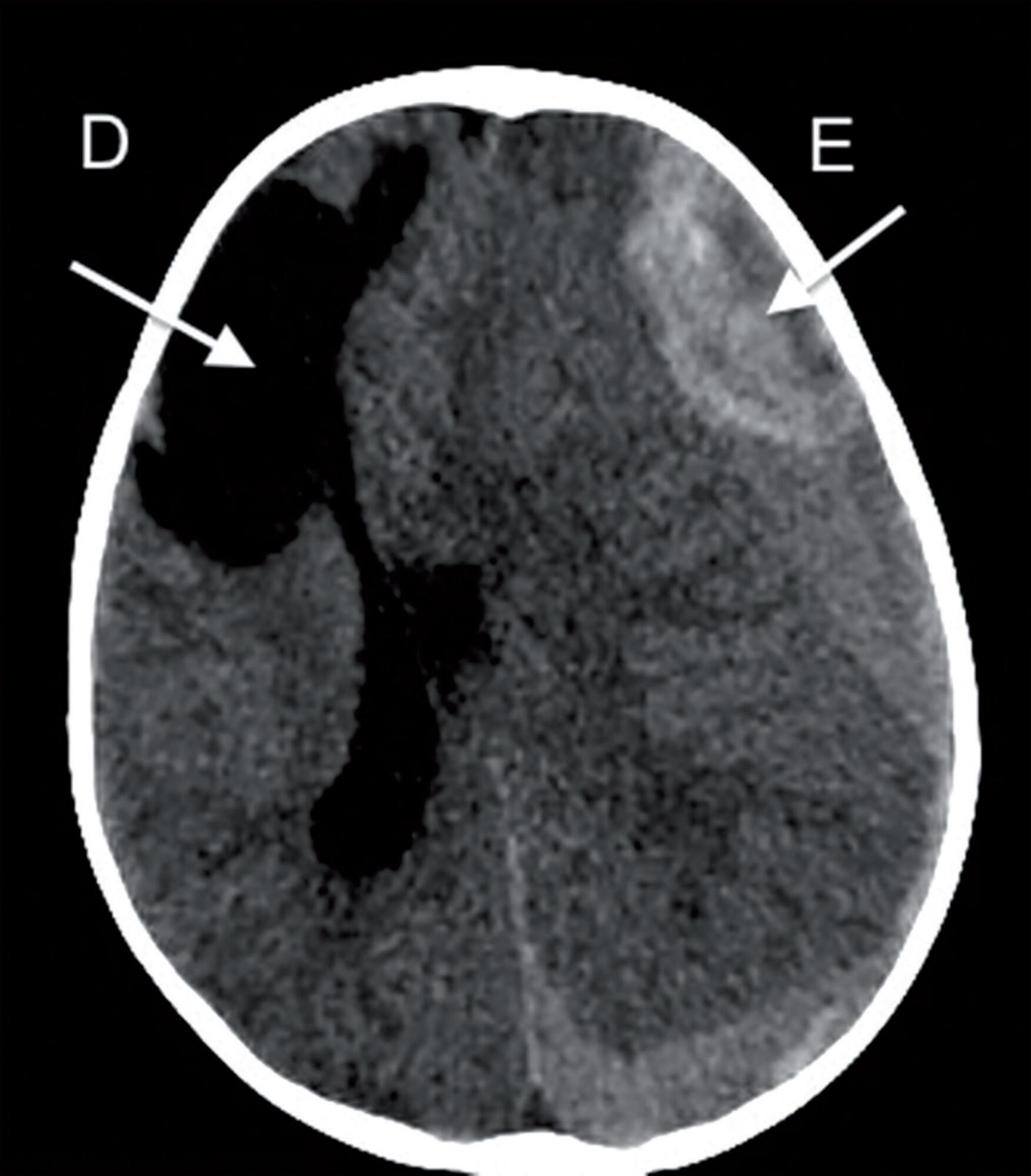 Spontaneous intracranial hemorrhage in children: report of a hemophilia patient who survived due to a brain cyst