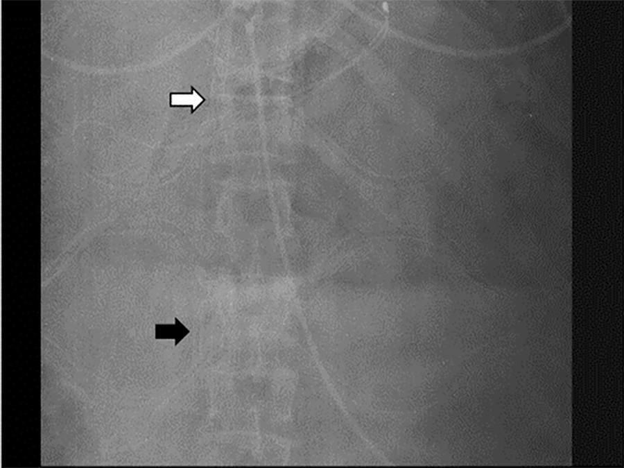 Uso de cânula venovenosa com duplo-lúmen para oxigenação por membrana extracorpórea em paciente com síndrome de angústia respiratória aguda com prévia inserção de filtro na veia cava inferior: relato de caso