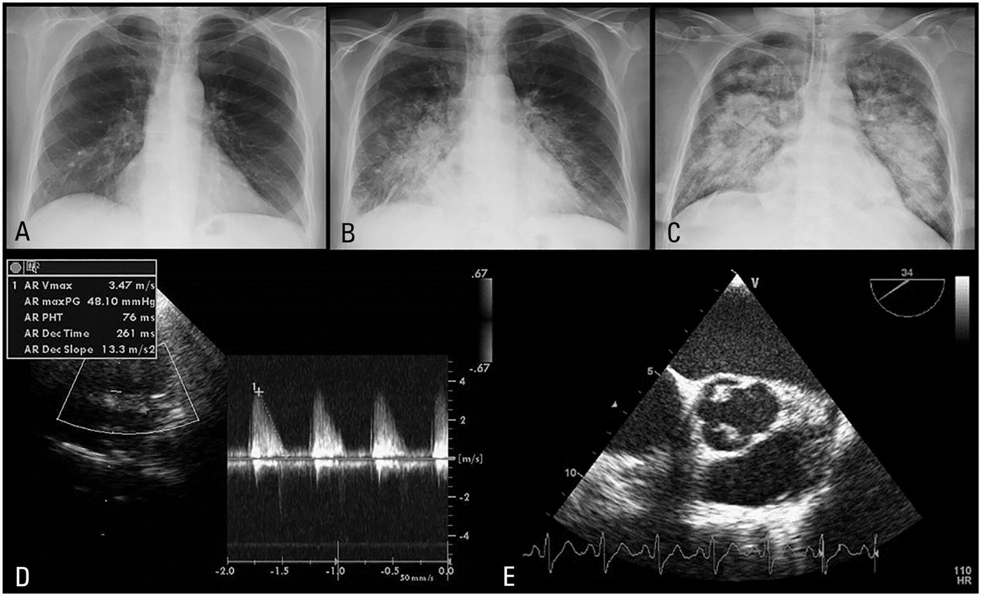 Native aortic valve pneumococcal endocarditis – fulminant presentation
