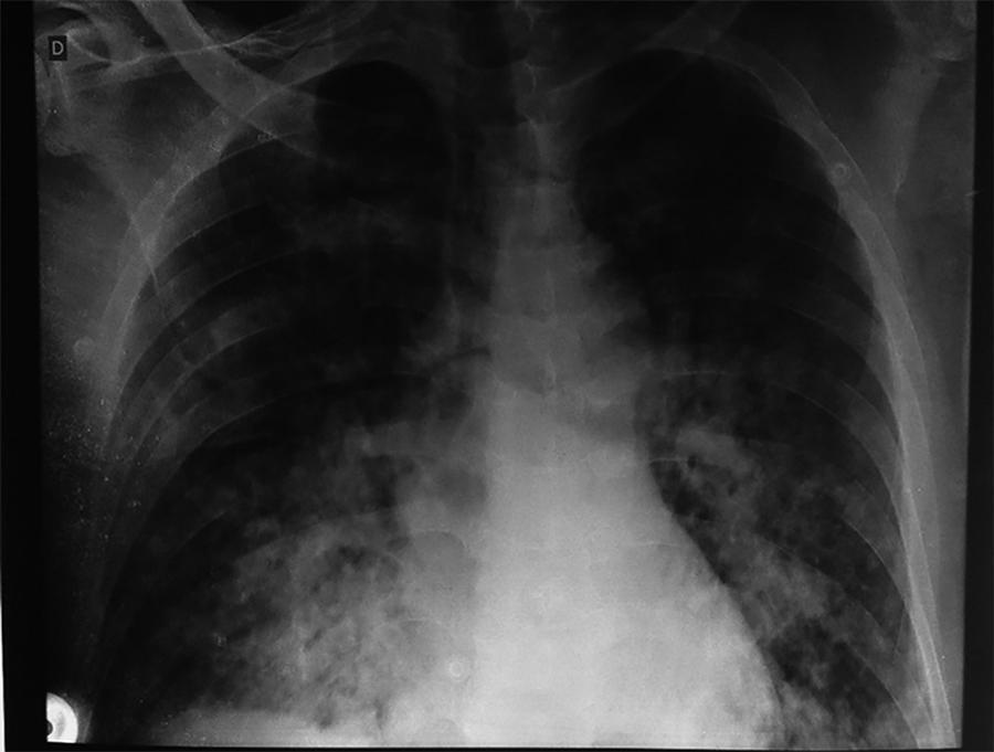 Uso da ventilação não invasiva em síndrome do desconforto respiratório agudo grave por inalação acidental de cloro: um relato de caso