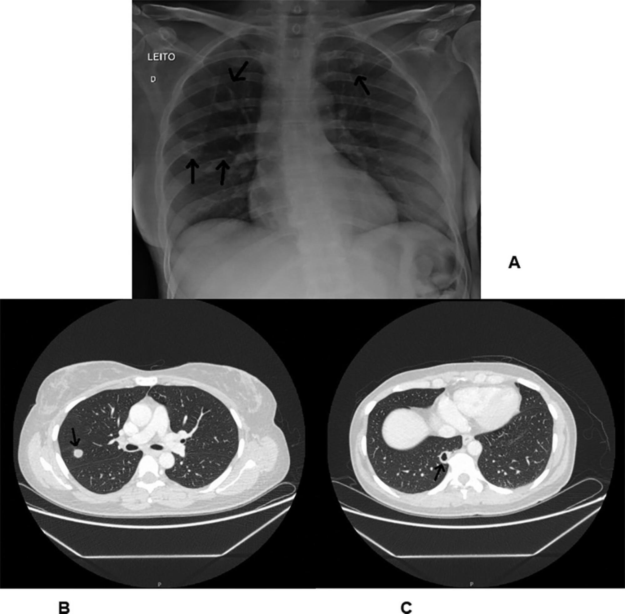 Heart conduction system defects and sustained ventricular tachycardia complications in a patient with granulomatosis with polyangiitis. A case report and literature review