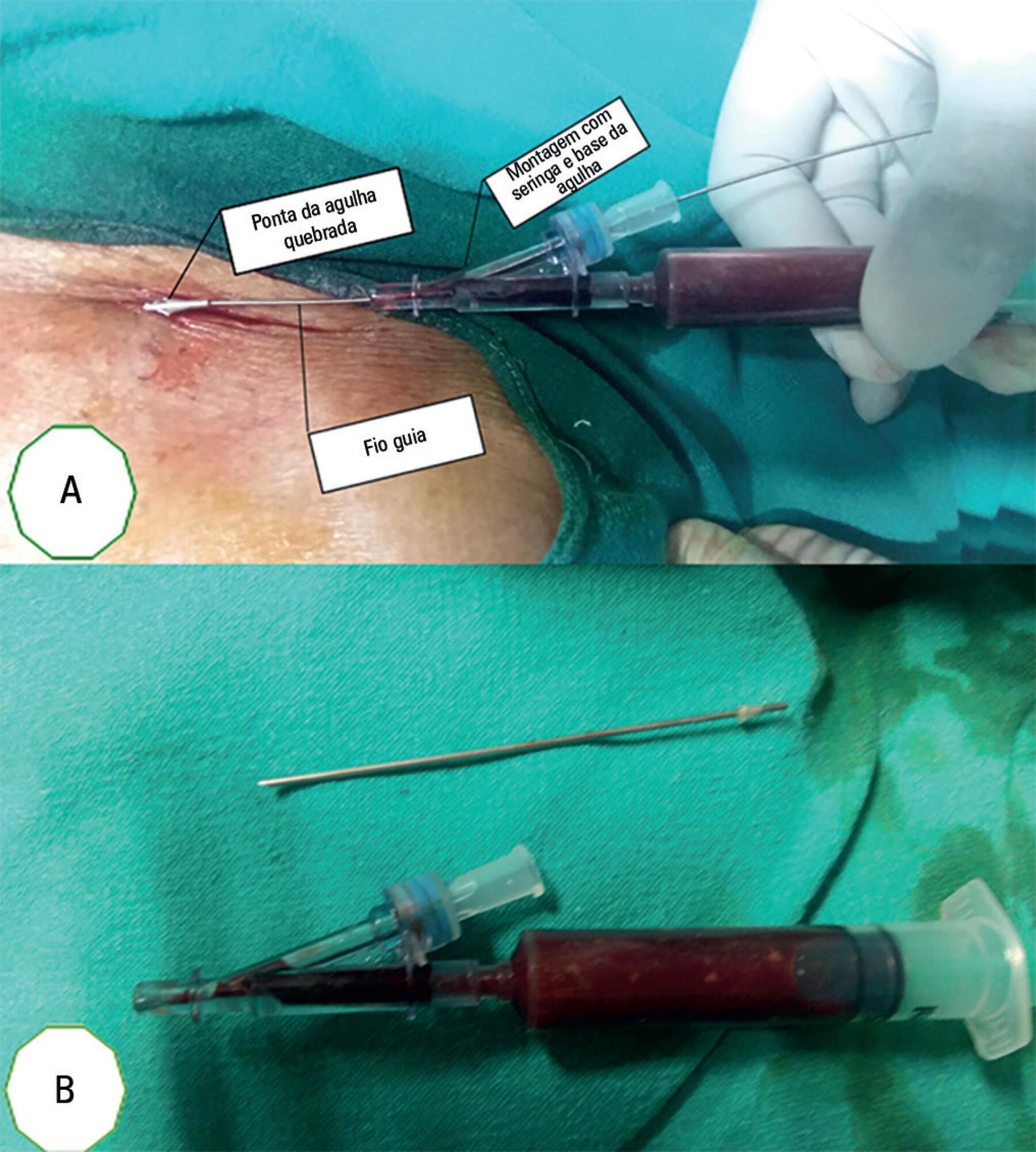 Accidental breakage of needle during subclavian vein catheterization: an adversity uncalled for!