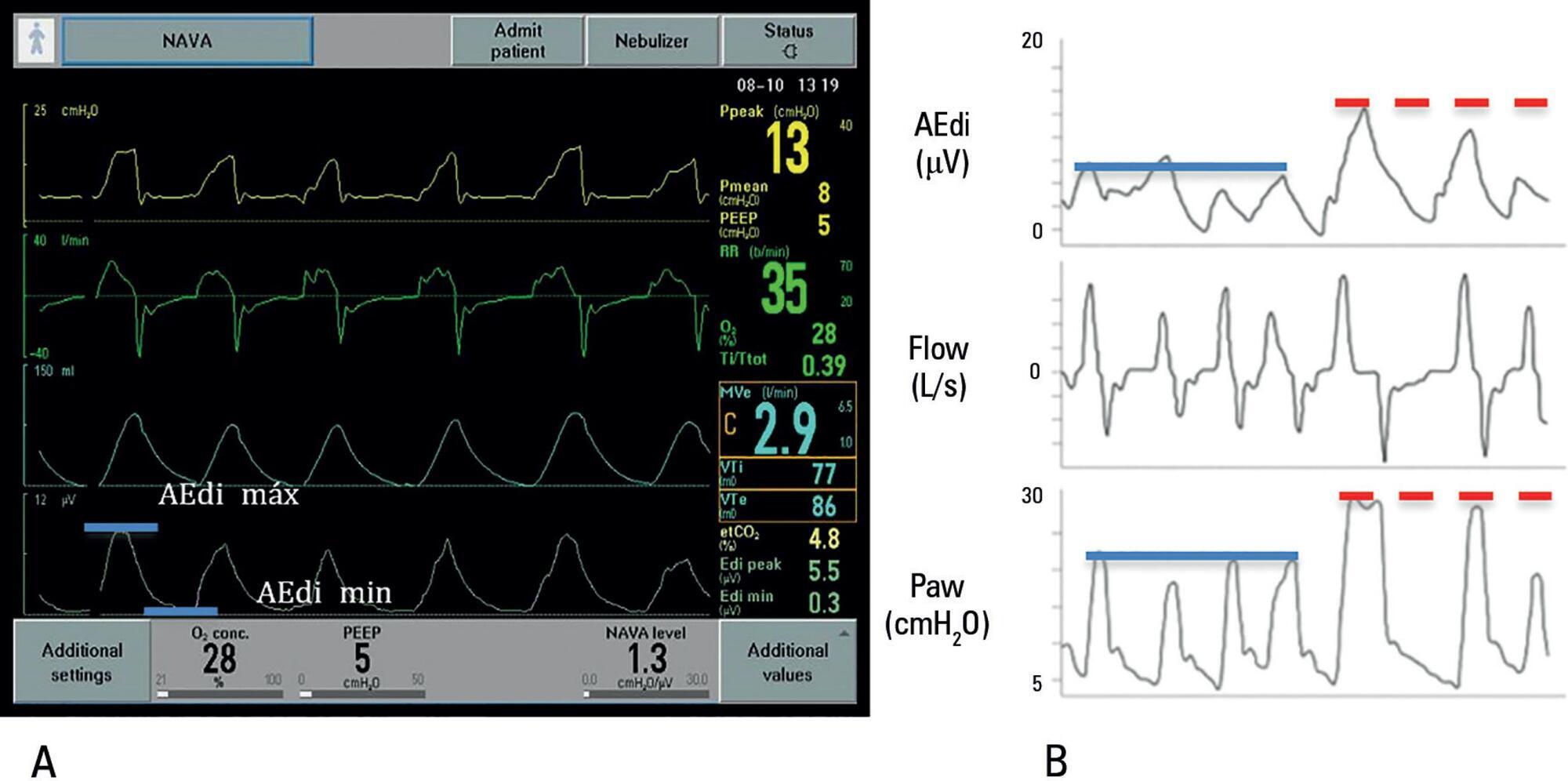 Neurally adjusted ventilatory assist in pediatrics: why, when, and how?