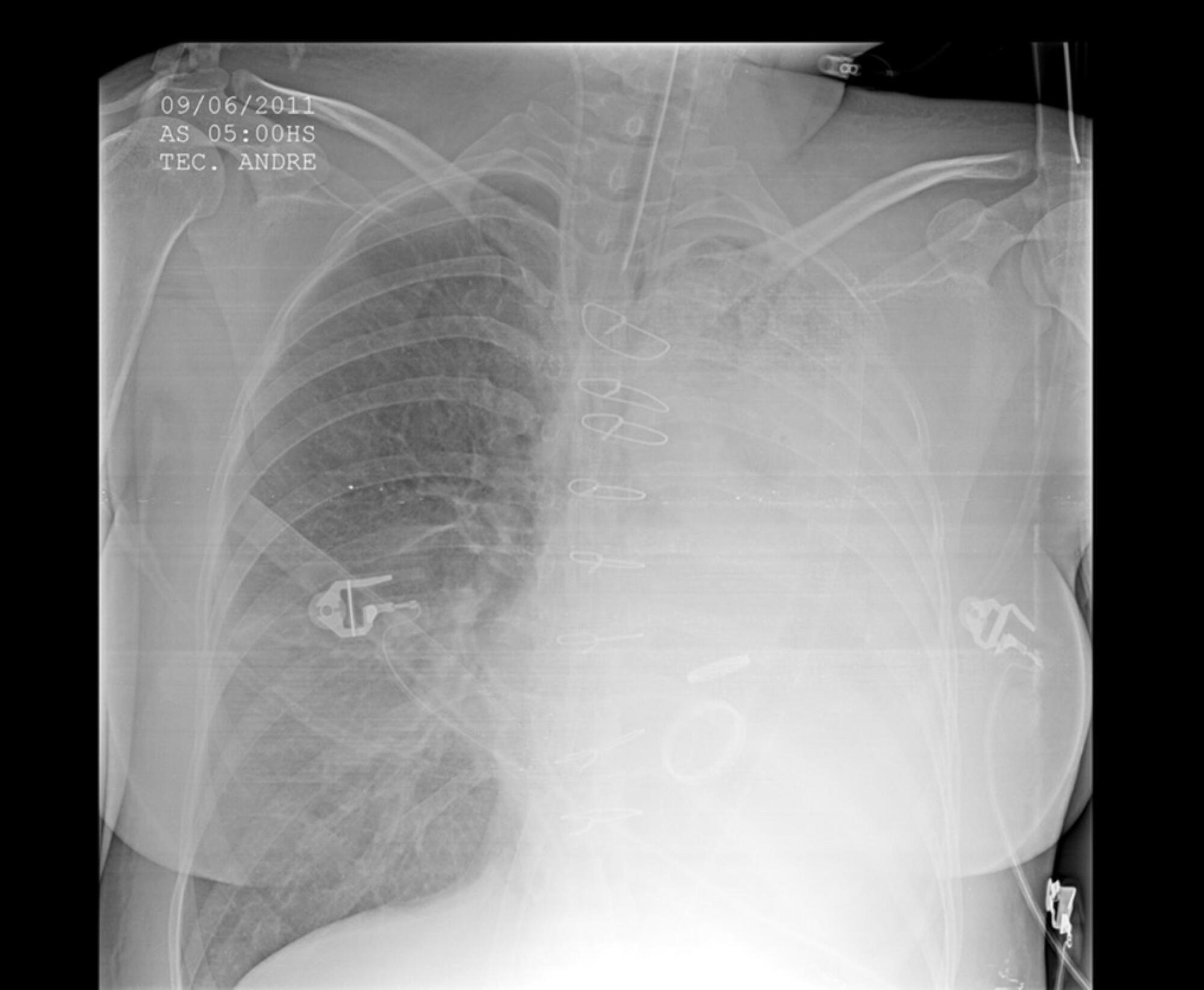 Massive hemoptysis successfully treated with extracorporeal membrane oxygenation and endobronchial thrombolysis