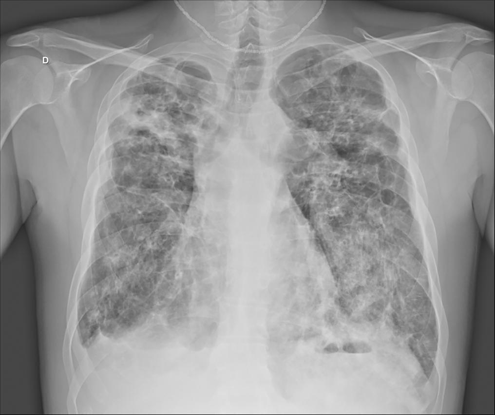 Influenza A non-H1N1 associated with acute respiratory failure and acute renal failure in a previously vaccinated cystic fibrosis patient