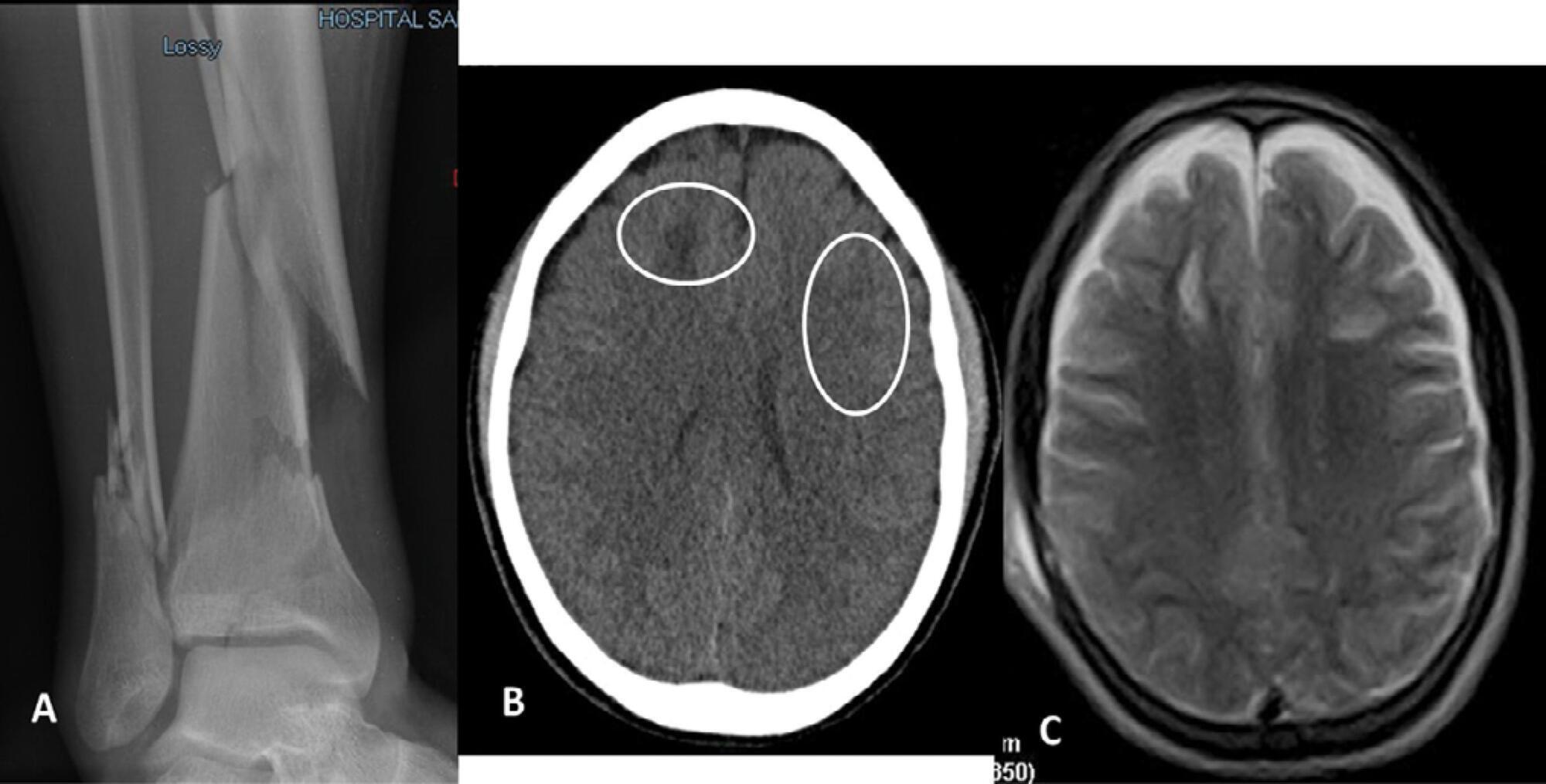 Paroxysmal sympathetic hyperactivity syndrome caused by fat embolism syndrome
