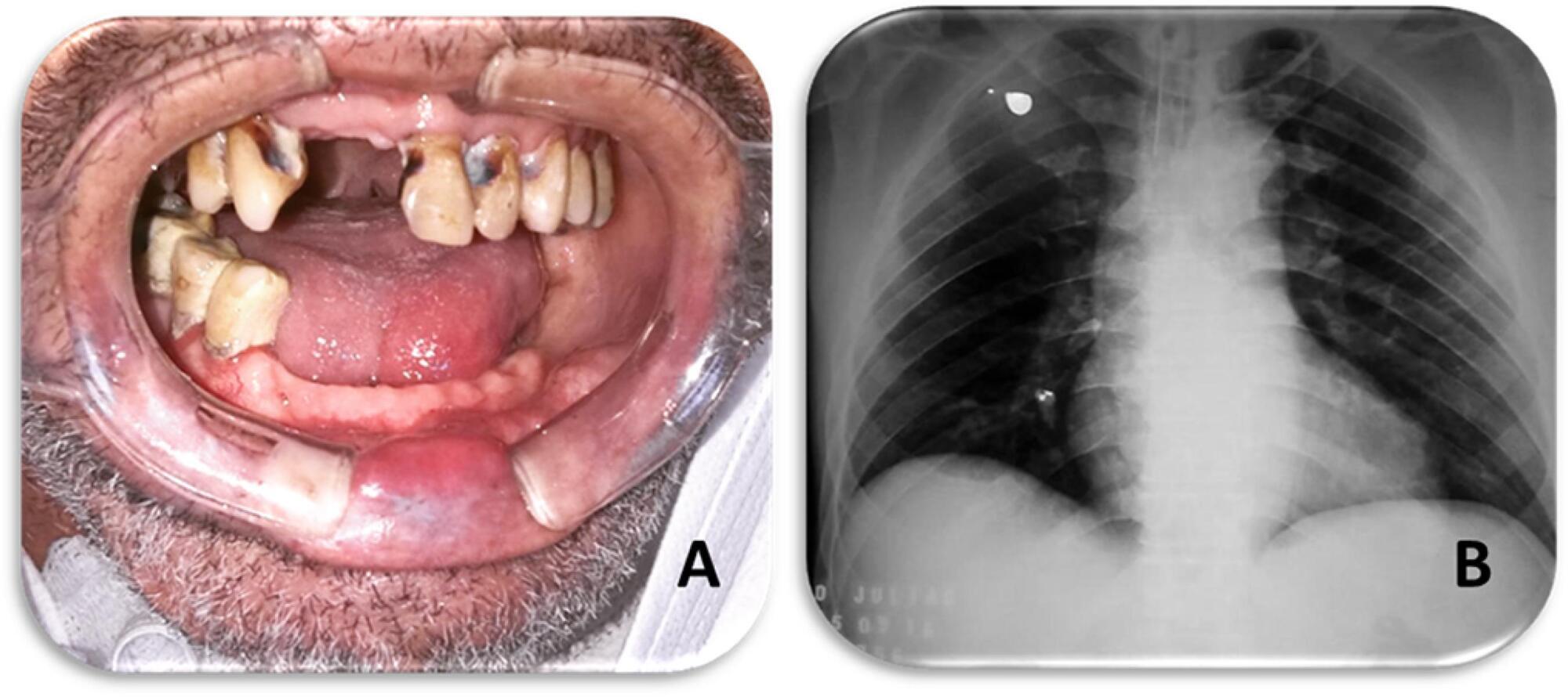 Periodontal disease and bronchoaspiration in a neurovegetative patient