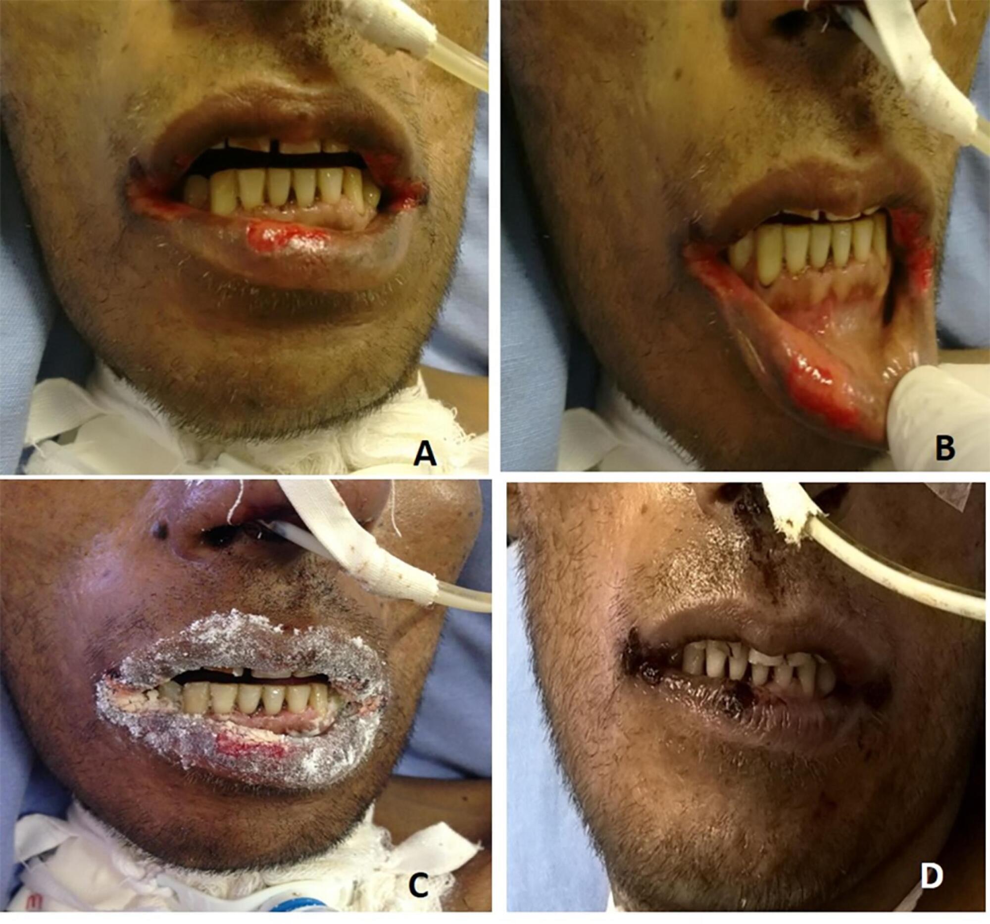 Use of topical glutamine as an adjuvant for the treatment of oral ulcers