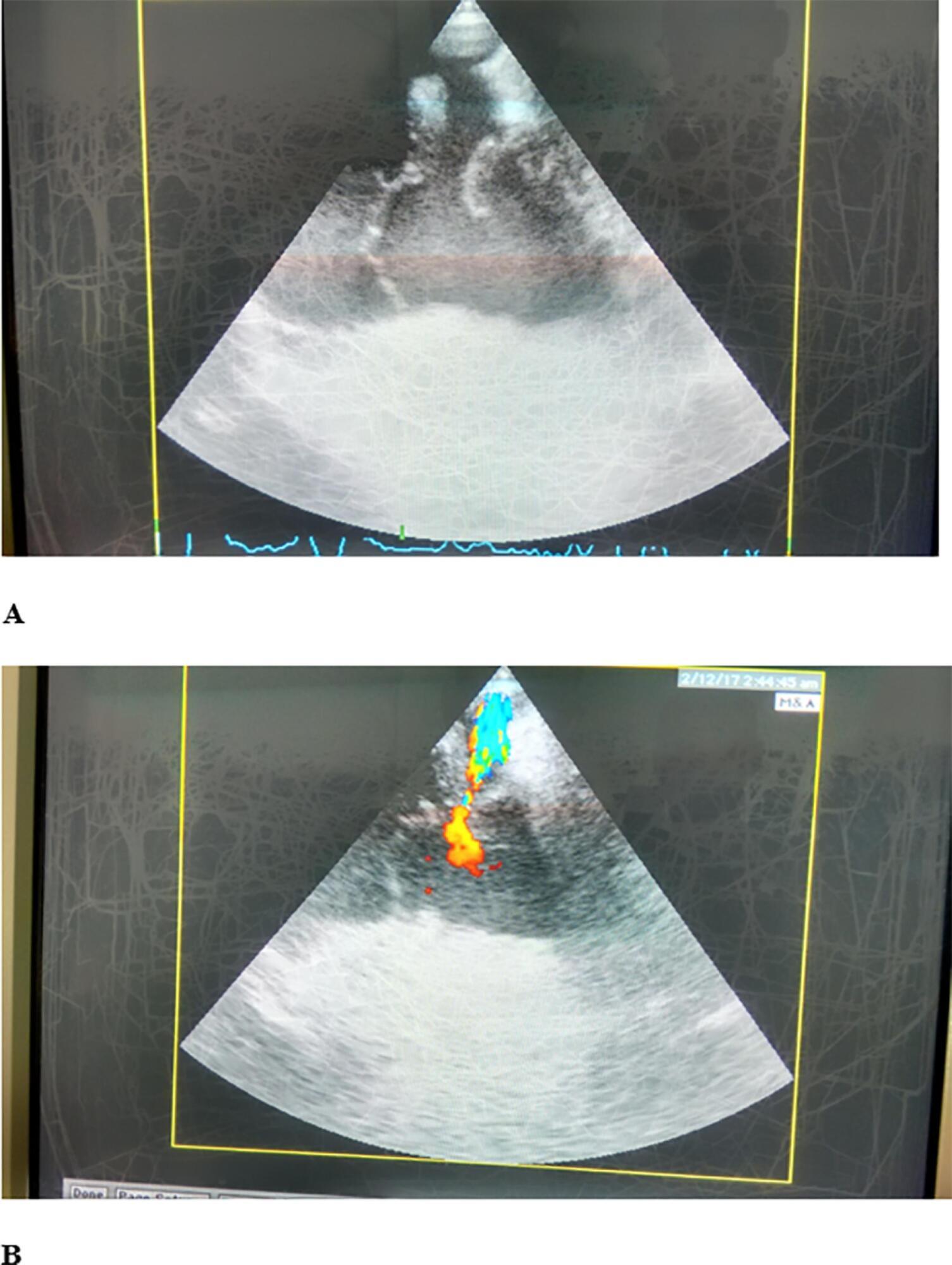 Traumatic tricuspid valve papillary muscle case with concomitant acquired patent foramen ovale and covert right atrial rupture
