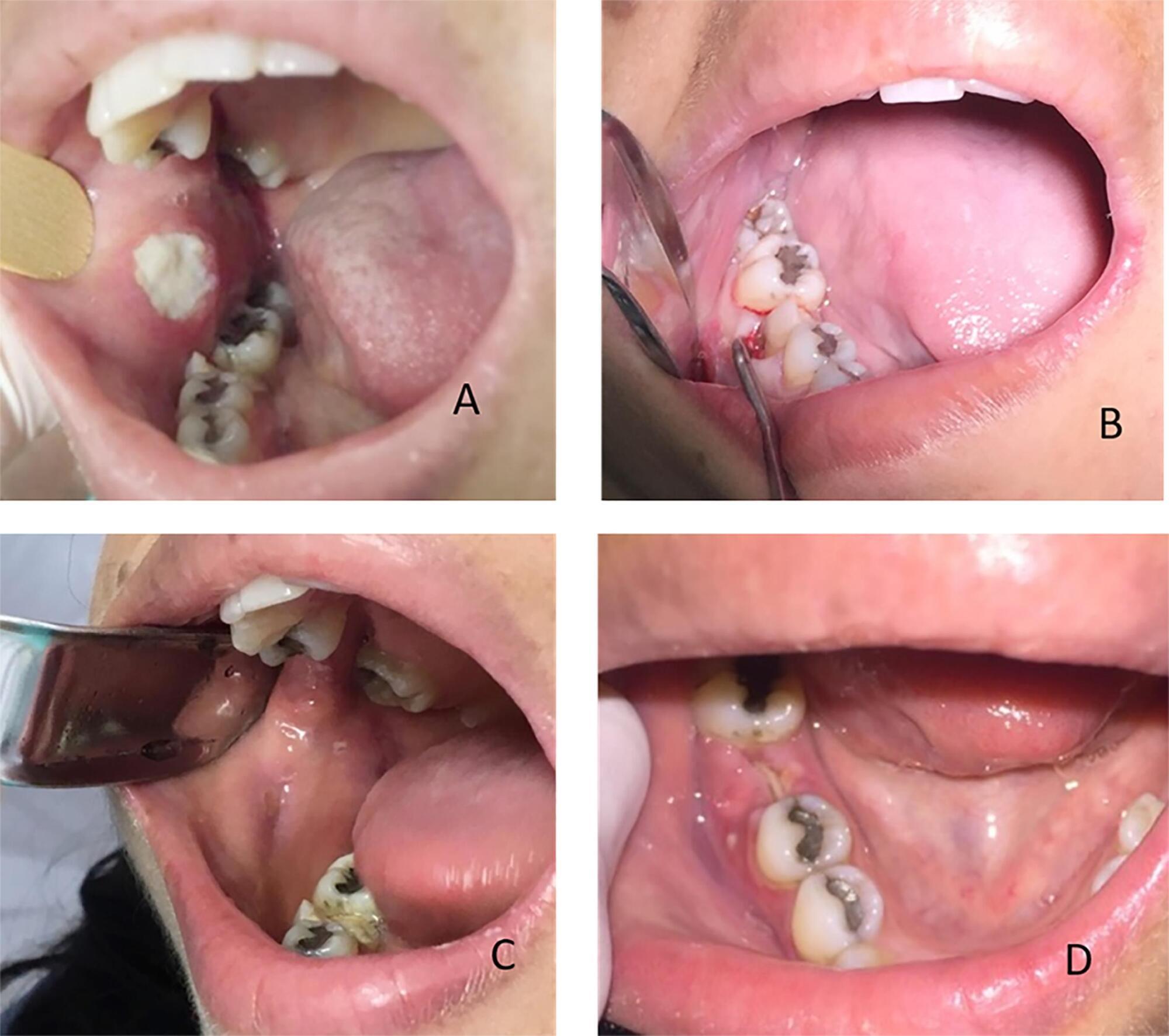 Extensive oral ulcer in a patient with lupus erythematosus