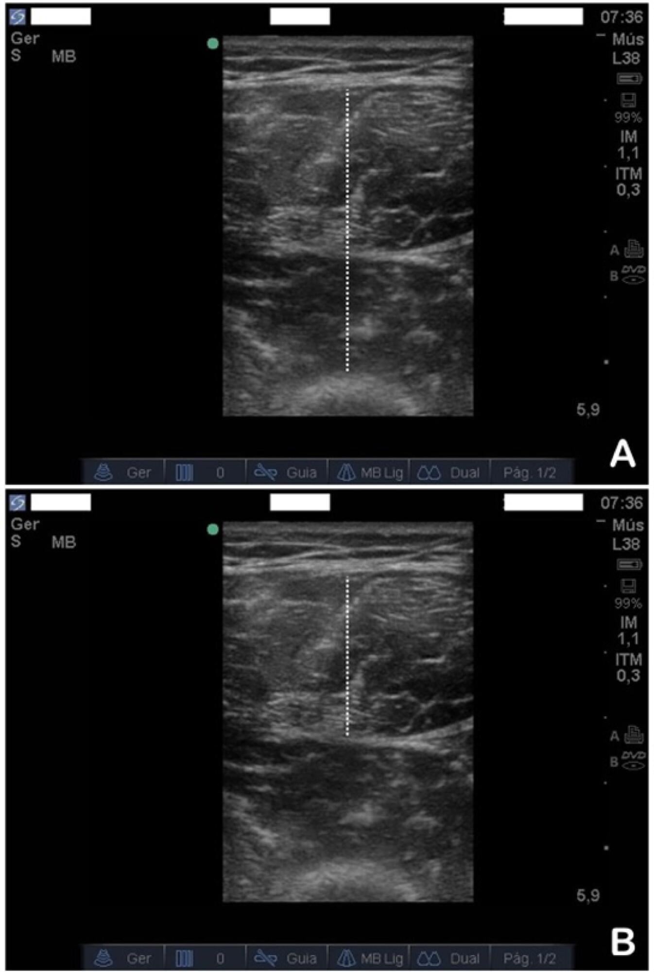 Confiabilidade da ultrassonografia de músculos esqueléticos em pacientes críticos de trauma