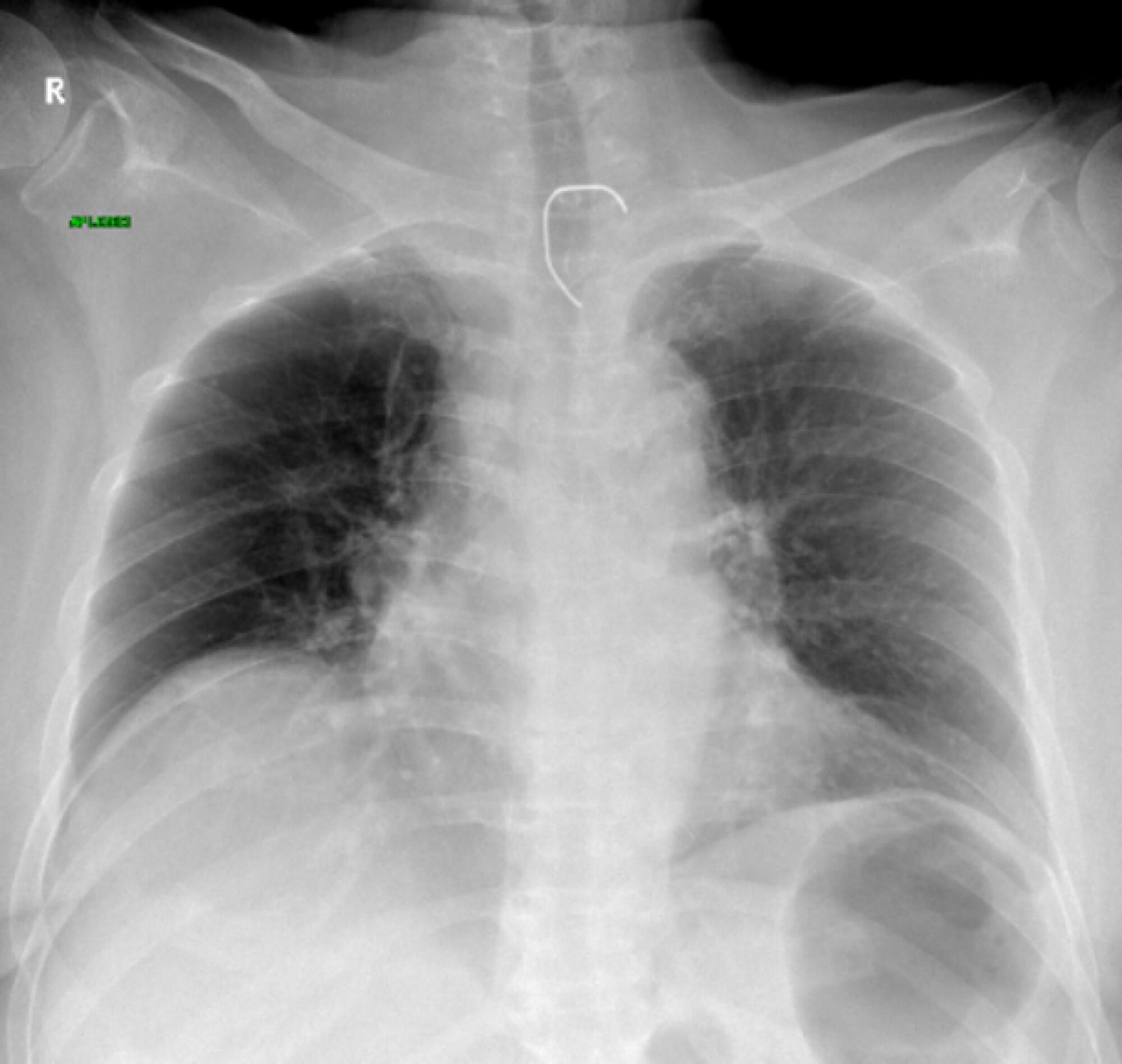 Multiple organ dysfunction caused by a foreign body in the esophagus
