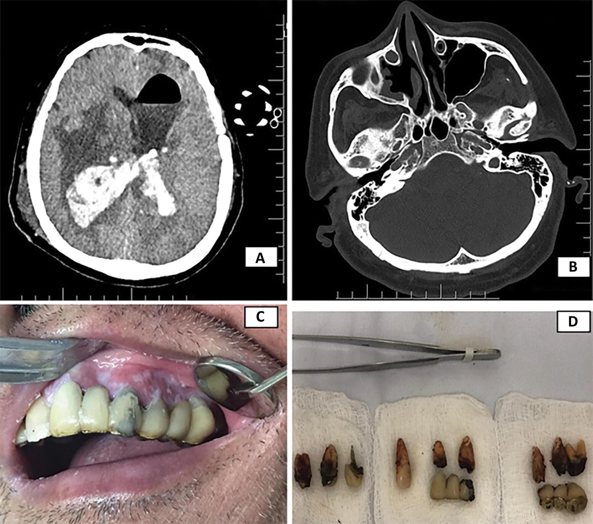 Brain abscess and odontogenic infection