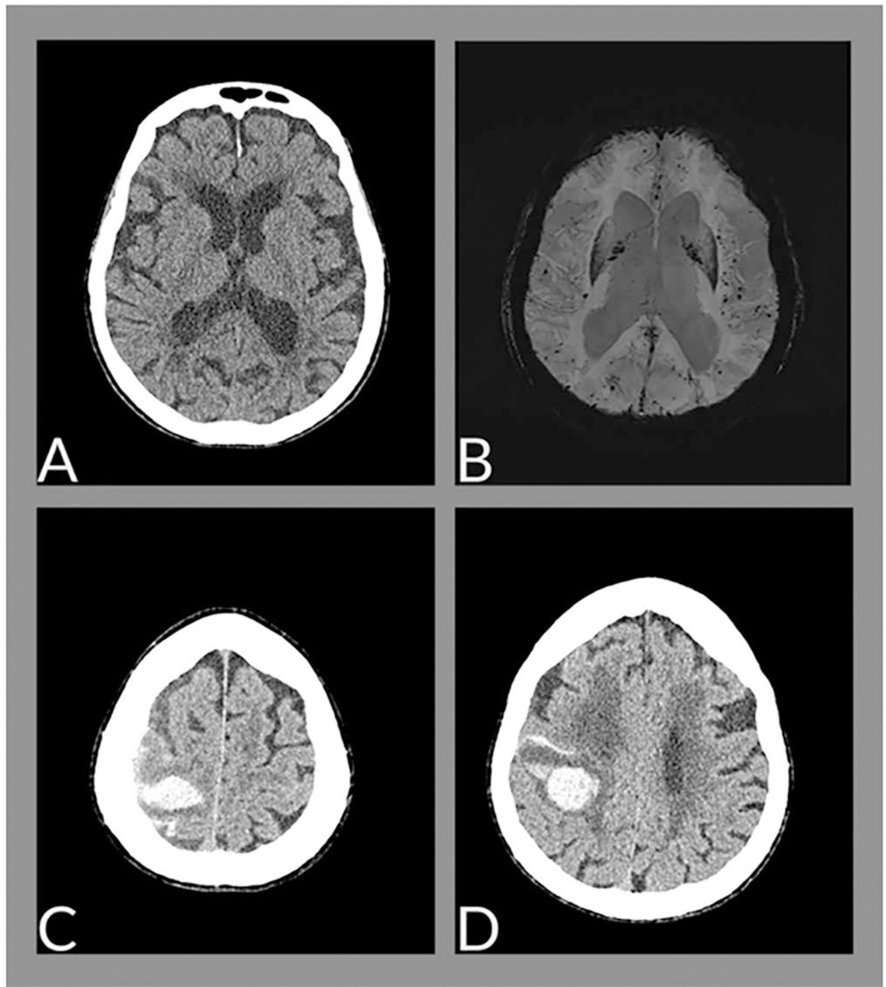 Cerebral hemorrhage during the active phase of SARS-CoV-2 infection in a patient with amyloid angiopathy: case report
