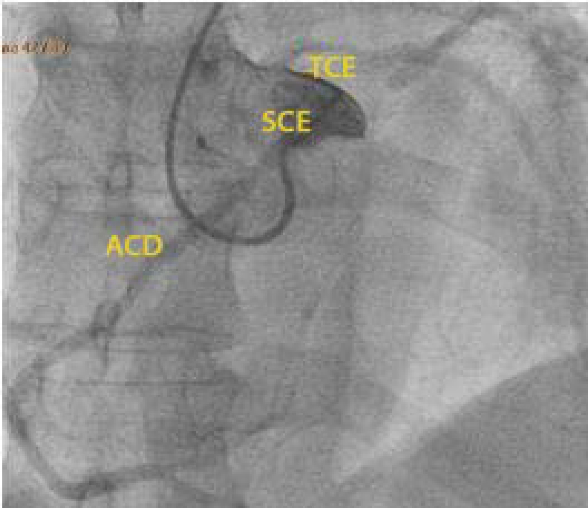 Cardiac arrest due to an anomalous aortic origin of a coronary artery: are older patients really safe?