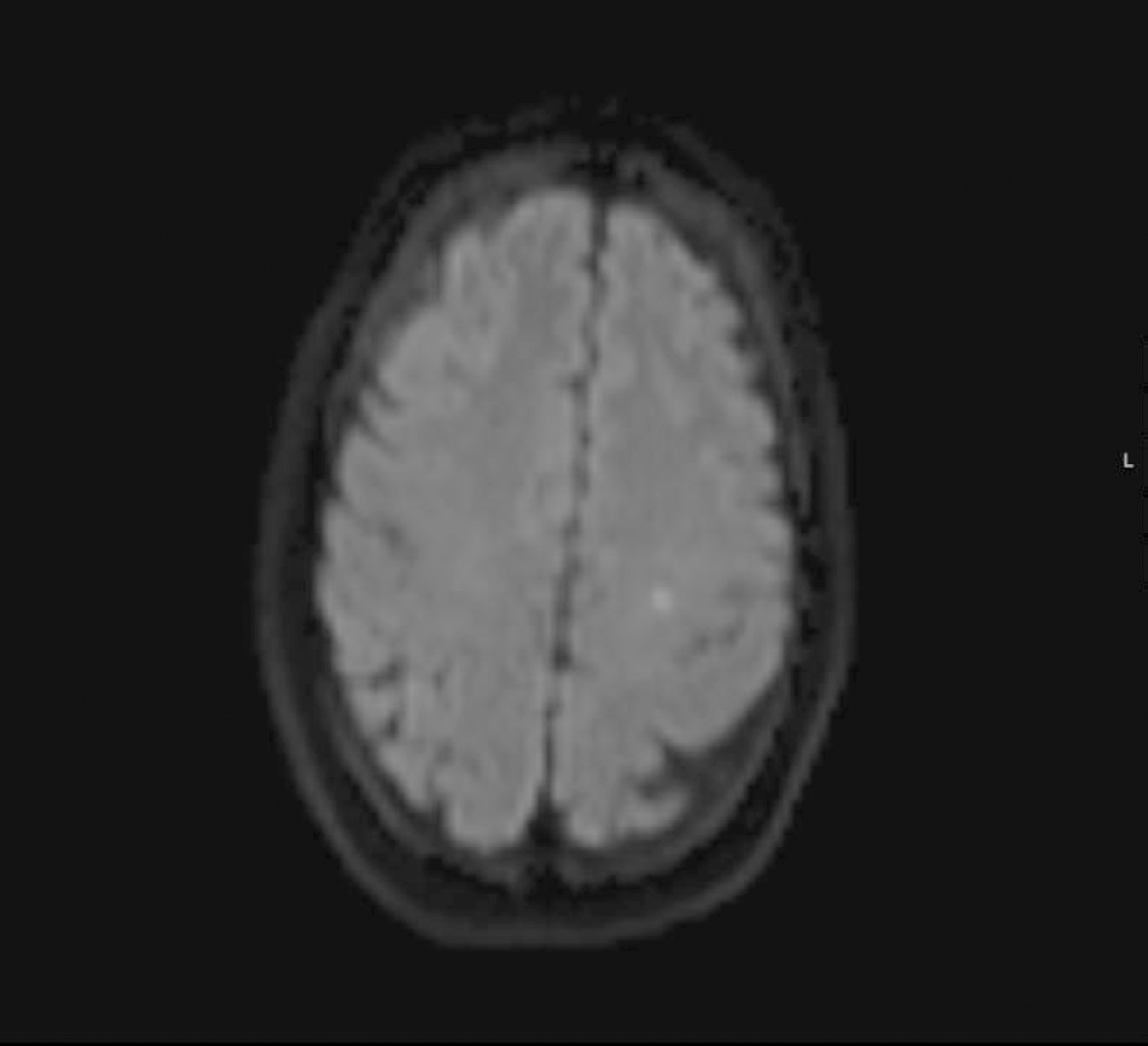 Reversible contrast-induced encephalopathy after coil embolization of epistaxis