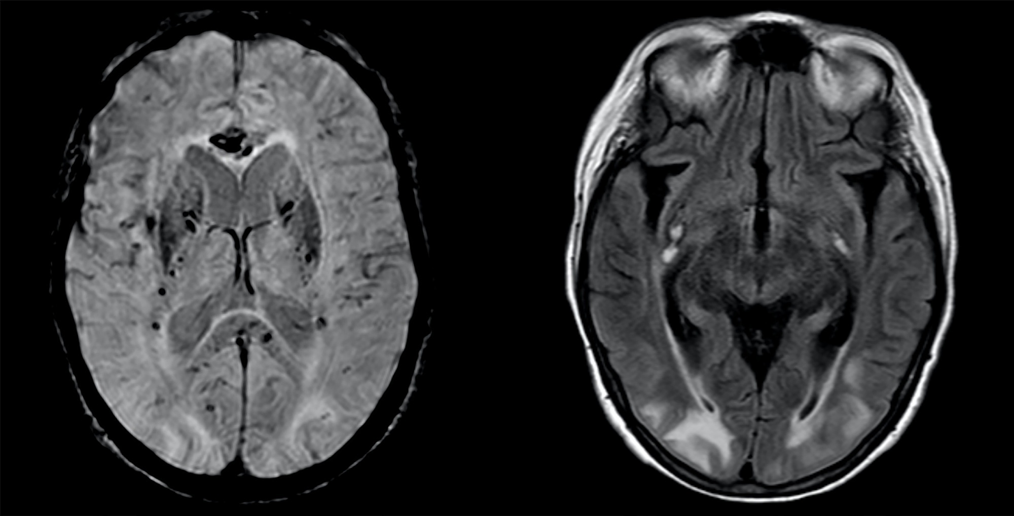 Síndrome da encefalopatia posterior reversível em paciente com COVID-19 submetida à oxigenação por membrana extracorpórea