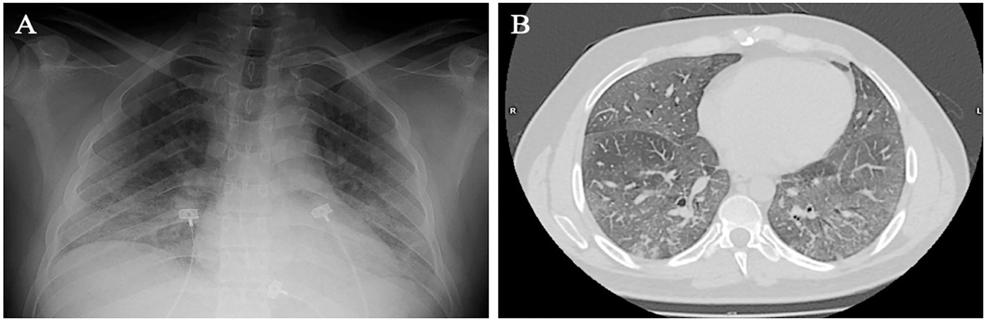 Self-inflicted lung injury: is it possible to identify the risk? A case report