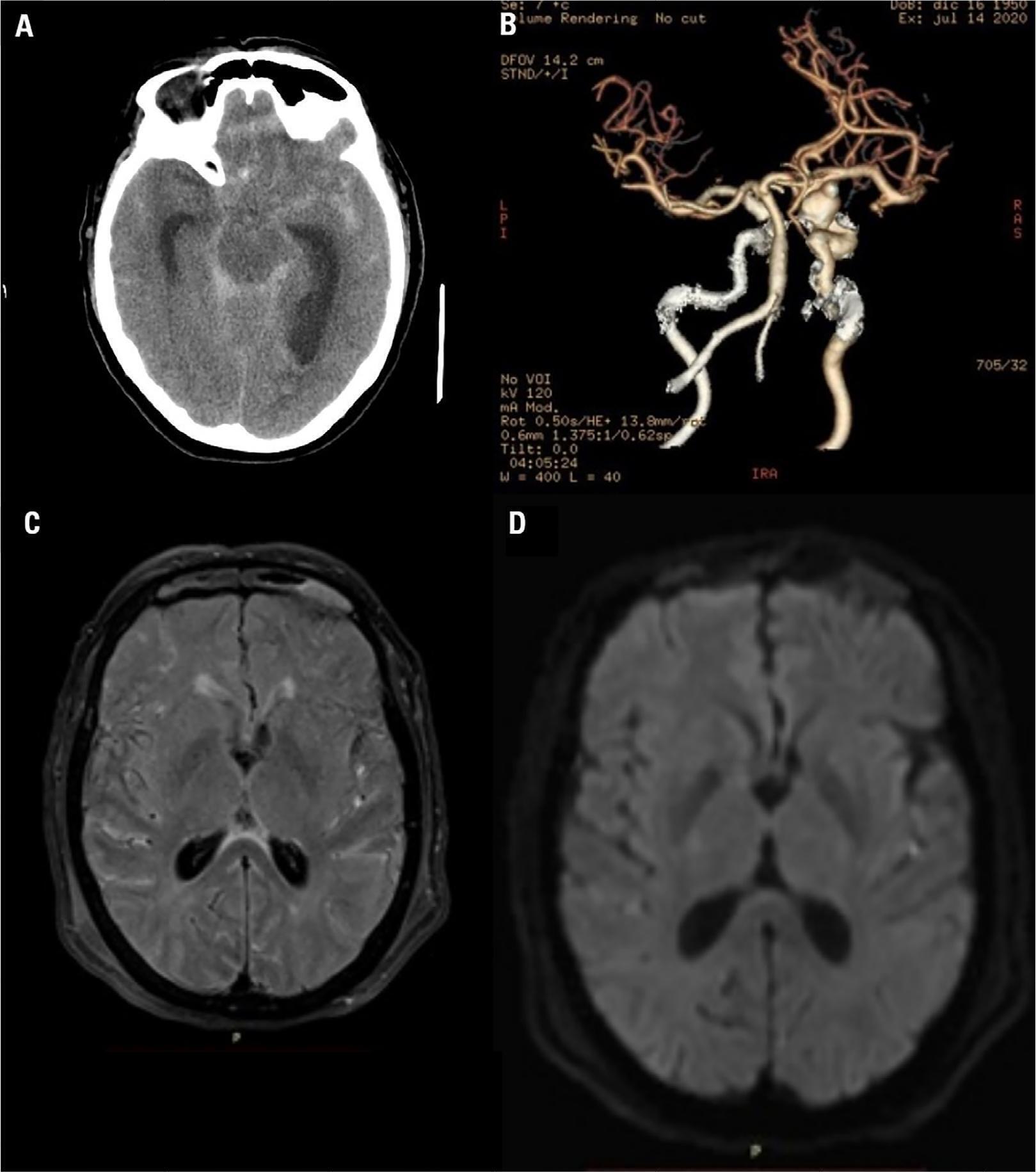 Valproate-associated hyperammonemic encephalopathy in subarachnoid hemorrhage: a diagnosis to consider