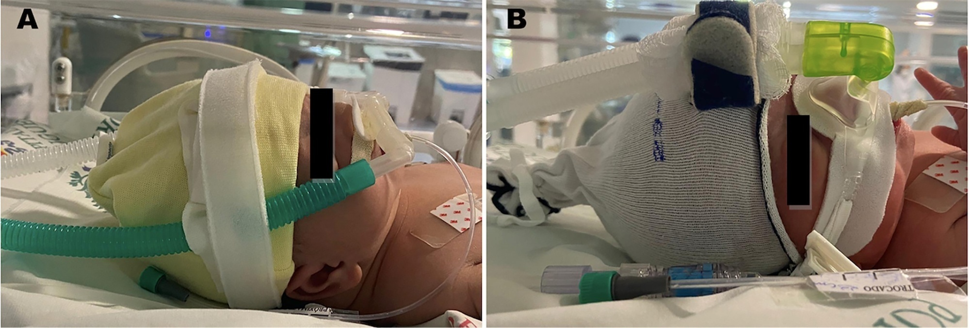 Rotating nasal masks with nasal prongs reduces the incidence of moderate to severe nasal injury in preterm infants supported by noninvasive ventilation