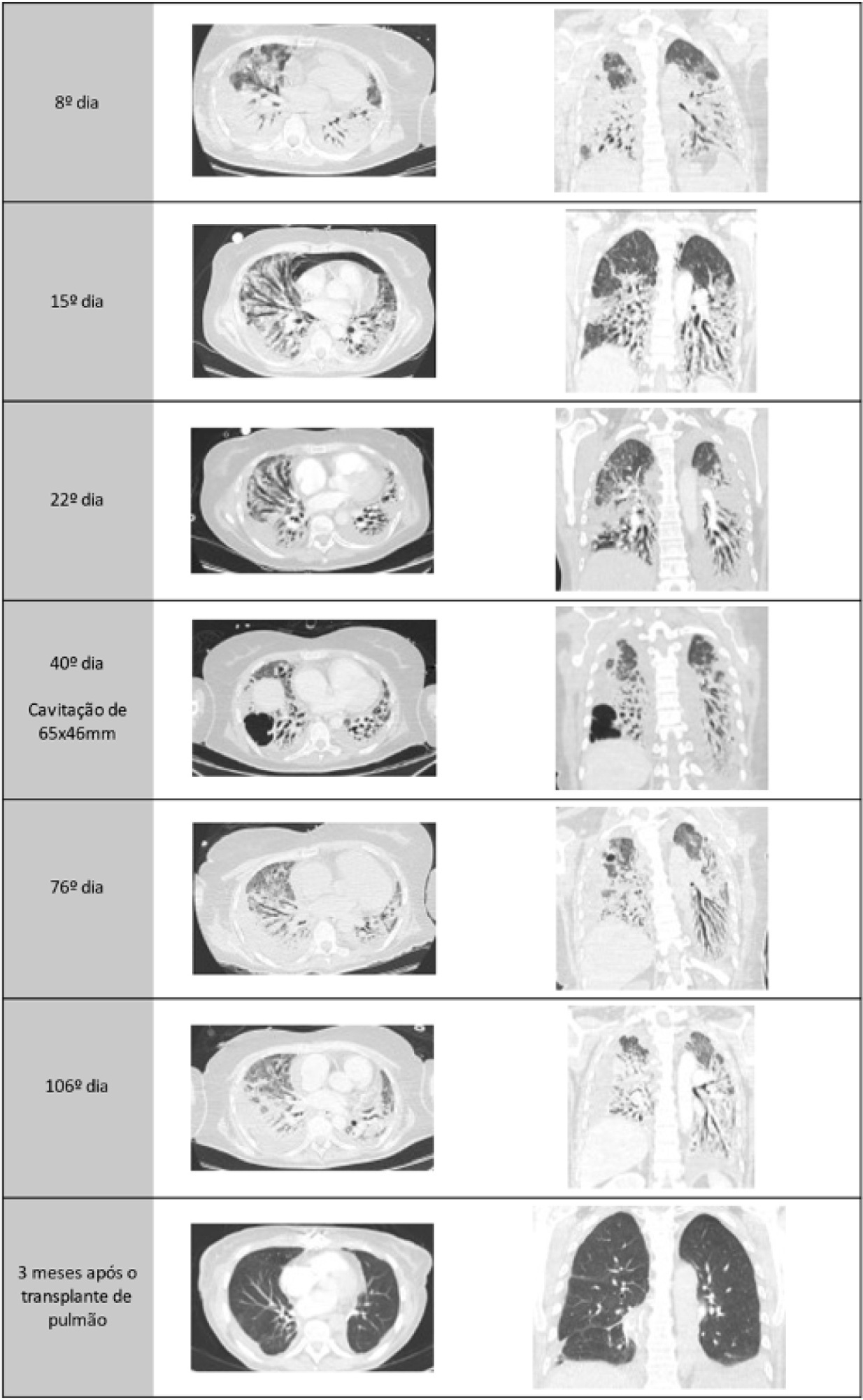 Long-term extracorporeal membrane oxygenation – from SARS-CoV-2 infection to lung transplantation