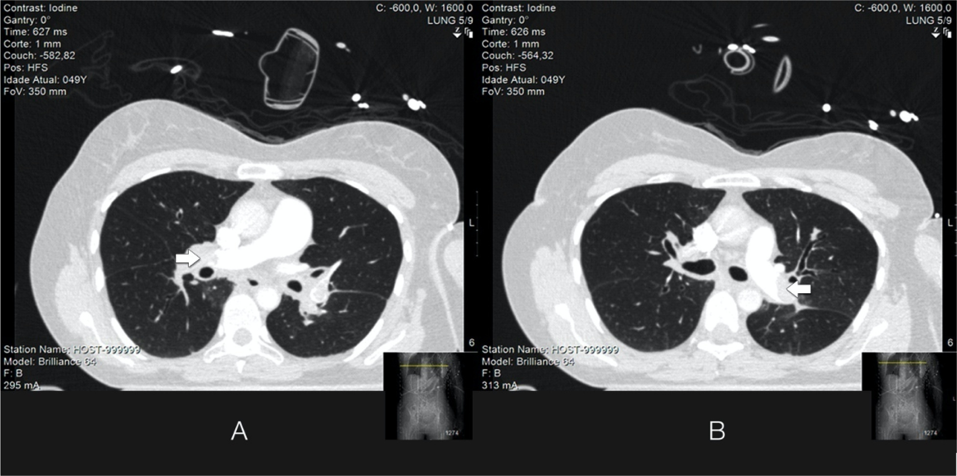 Extracorporeal mechanical support and aspiration thrombectomy in treatment of massive pulmonary embolism: a case report