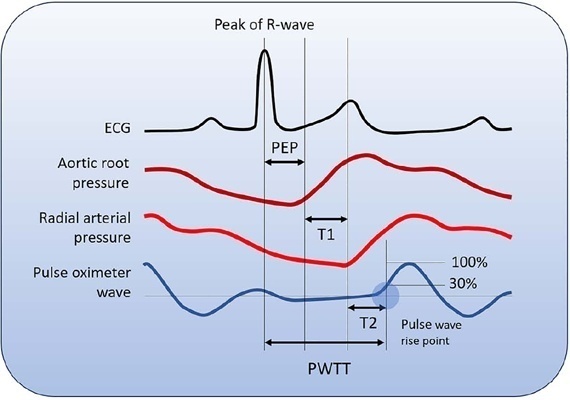 Estimated continuous cardiac output based on pulse wave transit time in critically ill children: a report of two cases